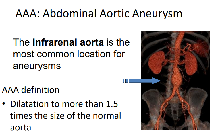 Abdominal Aortic Aneurysm Treatment Medical Management Dr